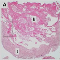 FMA squamous cell carcinoma.