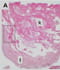 FMA squamous cell carcinoma.