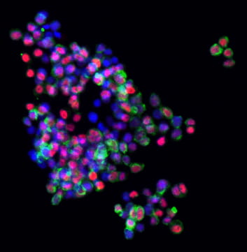 Tumoroid HNF4a CK19 - image taken by the Wu Lab.