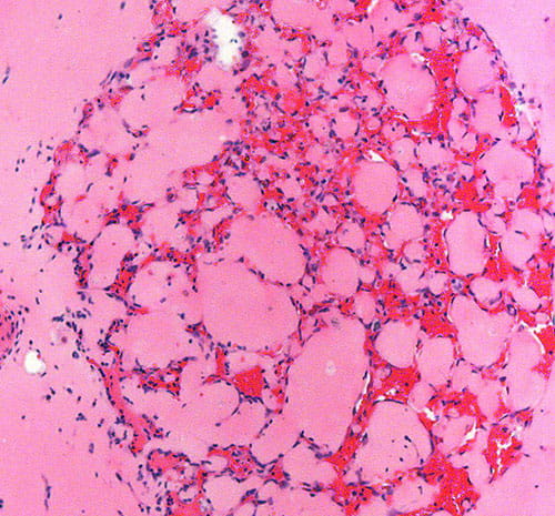 Diesel exhaust particles in macrophage.