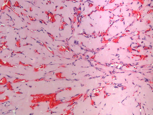 Arterial remodeling.