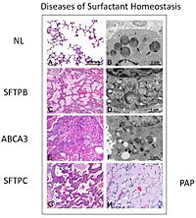 whitsett-visual1-450-surfactant-diseases