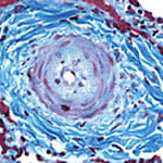 Pulmonary Vascular Diseases.