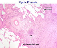 Lung biopsy.