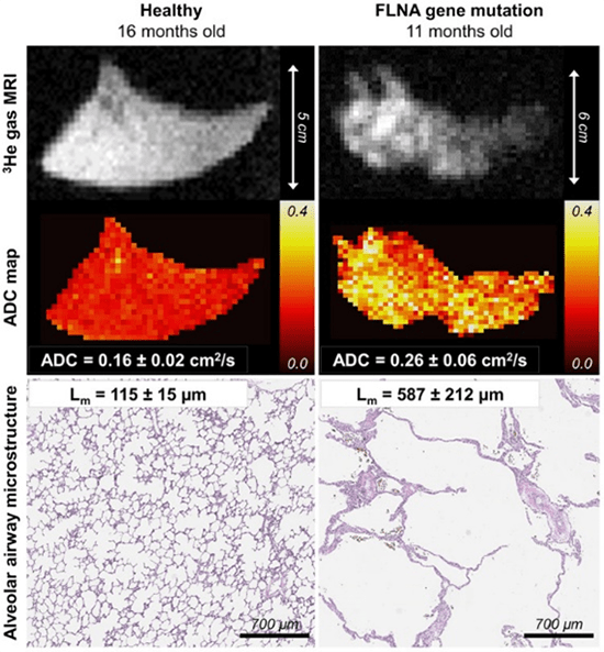 Inhaled helium-3 gas diffusion MRI.