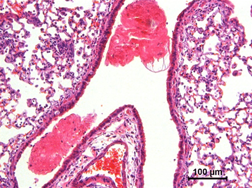 Hematoxylin and eosin stain demonstrating airway mucus plugging (pink) triggered by TGFbeta exposure in the mouse lung.