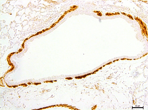 alphaSMA staining of smooth muscle (brown) demonstrating excessive airway smooth muscle around mouse airways after exposure to pulmonary TGFbeta.