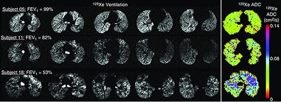 129Xe ventilation and apparent diffusion coefficient (ADC) map.