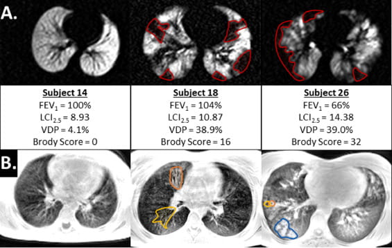 Example image slices for 129Xe (a.) and UTE (b.) images in CF subjects.