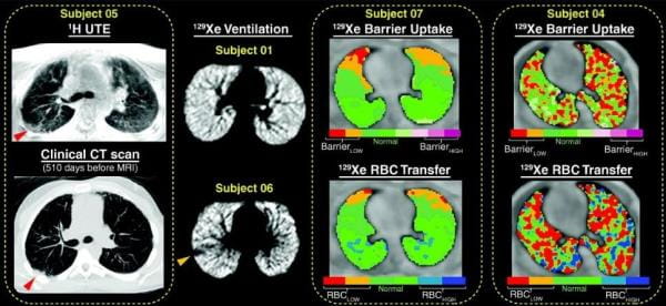 Summary of notable 1H and xenon 129 (129Xe) magnetic resonance imaging findings.