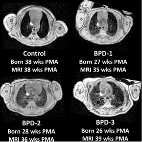 Neonatal MRI.