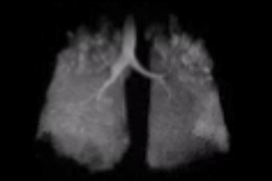 An MRI of a lung.