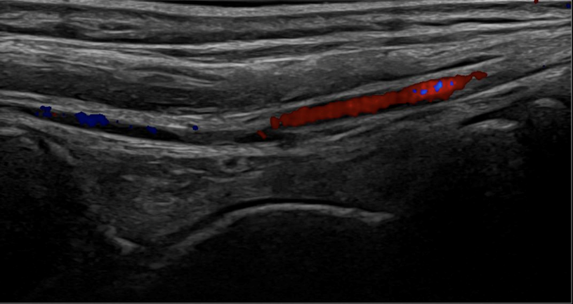 Musculoskeletal ultrasound of the ankle joint with normal findings in a 14-year-old male.
