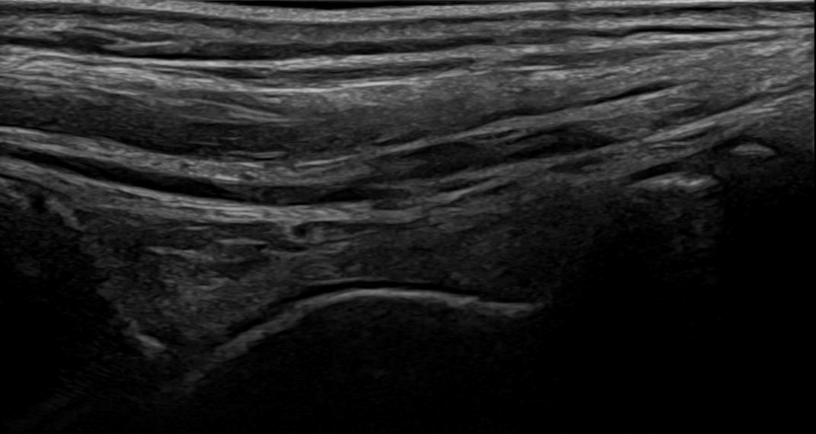 Musculoskeletal ultrasound of the ankle joint with normal findings in a 14-year-old male.