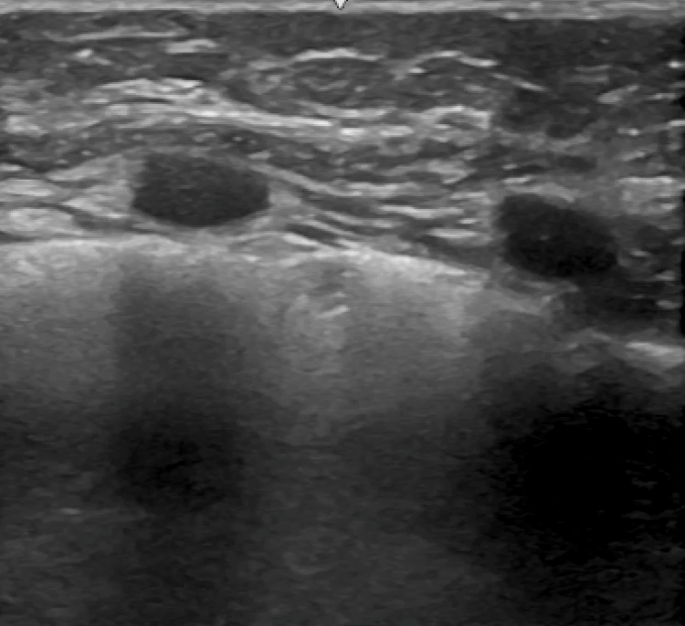Lung ultrasound in a 4-year-old female with systemic JIA.