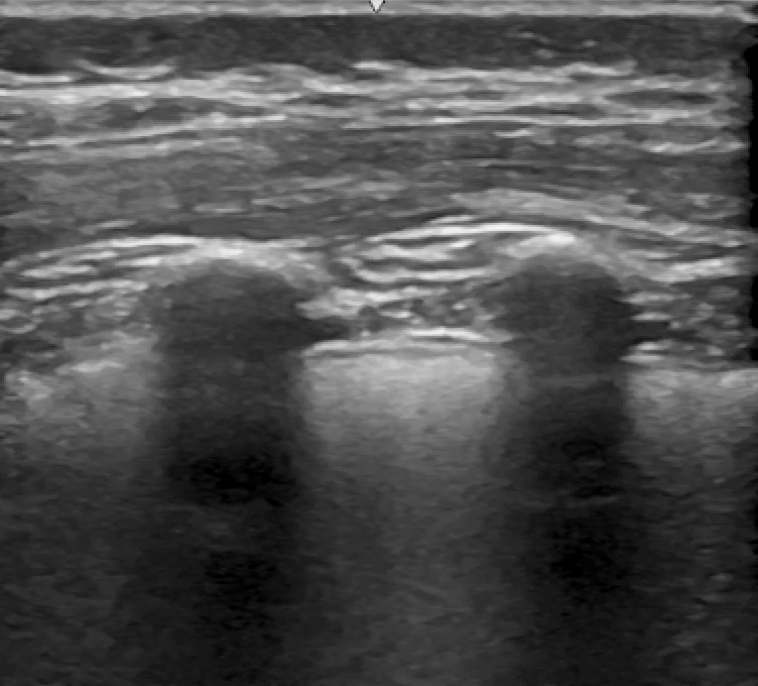 Lung ultrasound in a 4-year-old female with systemic JIA.