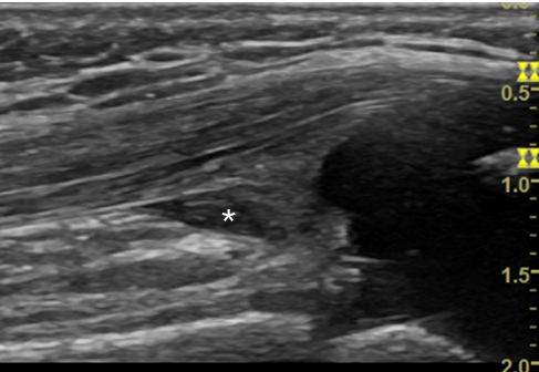An ultrasound image of a normal knee joint recess.
