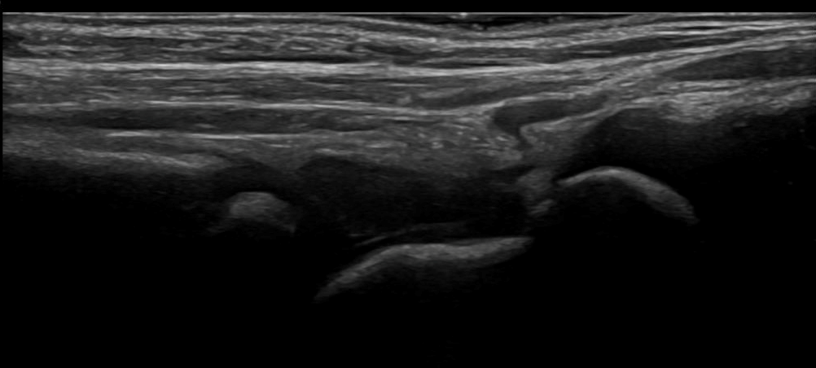 Musculoskeletal ultrasound of the ankle joint with abnormal findings in a 2-year-old female.