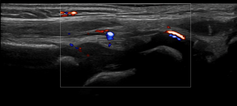 Musculoskeletal ultrasound of the ankle joint with abnormal findings in a 2-year-old female.