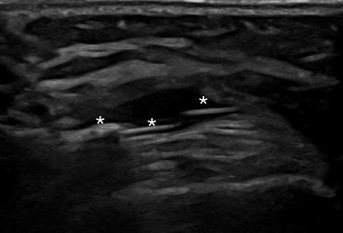 Ultrasound-guided synovial biopsy performed at the suprapatellar knee joint recess.