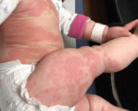 Picture of a skin rash.
