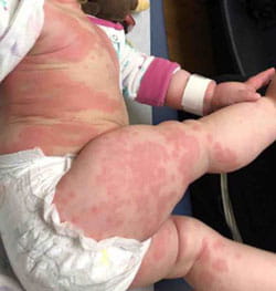 Skin rash visible on a baby.
