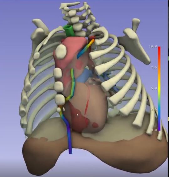 A 3D model of a patient's chest and heart using a set of 3D imaging tools.