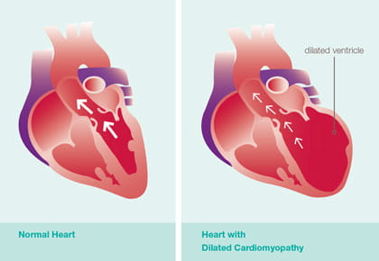 Dilated Cardiomyopathy illustration.