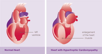 Hypertrophic Cardiomyopathy illustration.