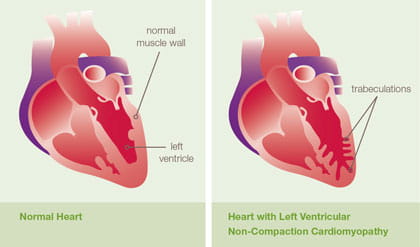 Left ventricular hypertrophy - Symptoms and causes - Mayo Clinic