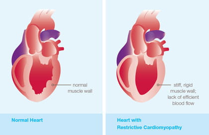 An illustration showing restrictive cardiomyopathy.