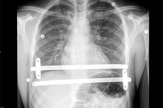 Chest X ray image.