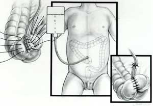 Appendicostomy illustration: The appendix is connected to the belly button so a tube can be passed through it for the enema administration.