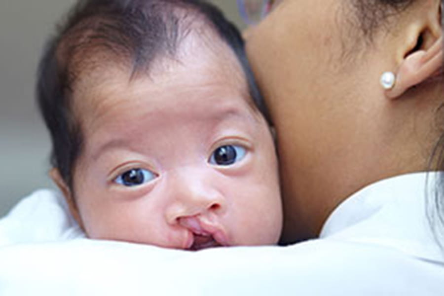 A patient of the Cleft and Craniofacial Center.