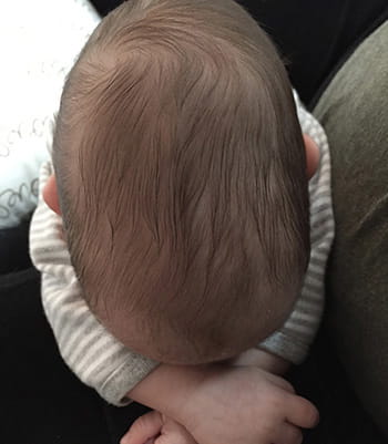 Above view of Austin's head before surgery.