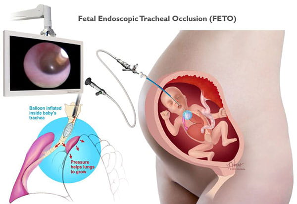 FETO Procedure