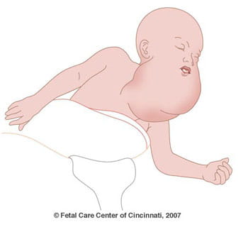 Cervical Teratoma Illustration