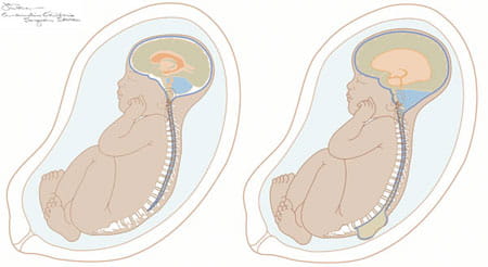 Myelomeningocele (MMC), the most severe form of spina bifida.