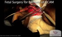 Watch: Fetal Surgery for Removal of Congenital Pulmonary Airway Malformation / CPAM.