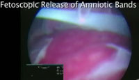 Watch a video clip of fetoscopic surgery to remove amniotic bands.