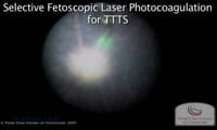 View a video clip of selective fetoscopic laser photocoagulation for Twin-Twin Transfusion Syndrome.