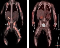 PET-CT images of a 10-month-old child with Langerhans cell histiocytosis (LCH).Three months after starting oral therapy with the drug dabrafenib, the image on the right shows near complete resolution of disease activity.