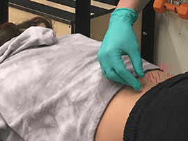 Dry needling in action.