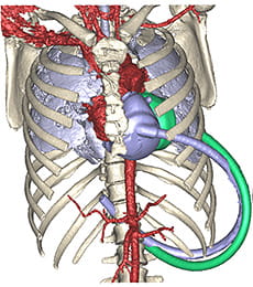 Fit Study Syncardia.