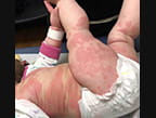 Rash-thumb