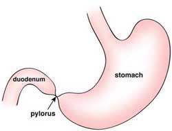 Intestinal Atresia & Stenosis | Types, Diagnosis & Treatment