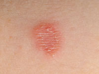 Tinea Capitis (Ringworm) | Skin Conditions in Children