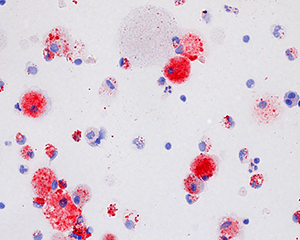Study Reports Taking A Pill Can Effectively Treat Brutal Lung Disease