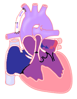 tricuspid atresia