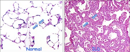 pay b bill Interstitial of Disease Lab Weaver Pathogenesis Lung pay b bill Interstitial of Disease Lab Weaver Pathogenesis Lung